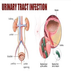 Urinary tract infections