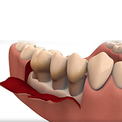 Periodontal Flap Surgery